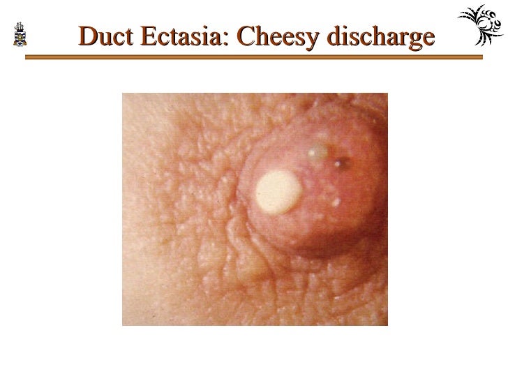 white milky discharge from breast White milky discharge from breast